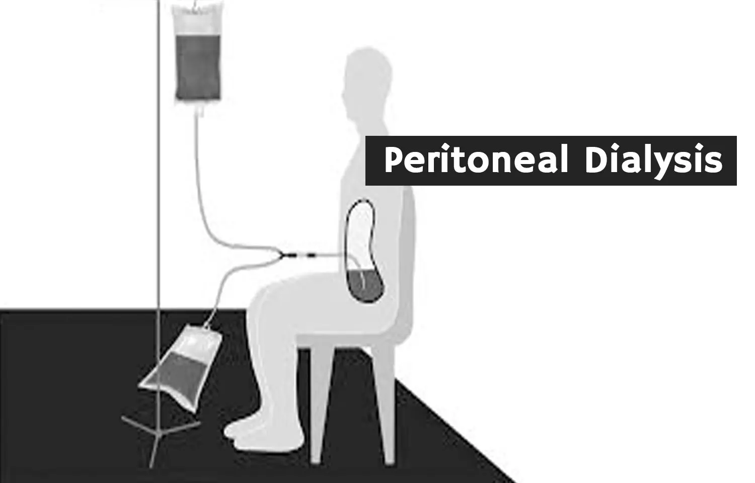 Peritoneal Dialysis