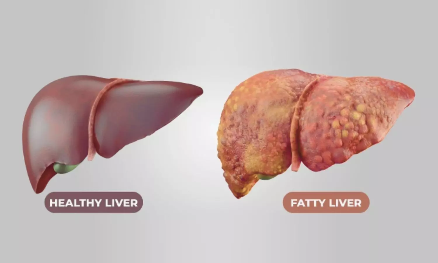 Obeticholic Acid may Improve outcomes in NASH-Related Liver Fibrosis