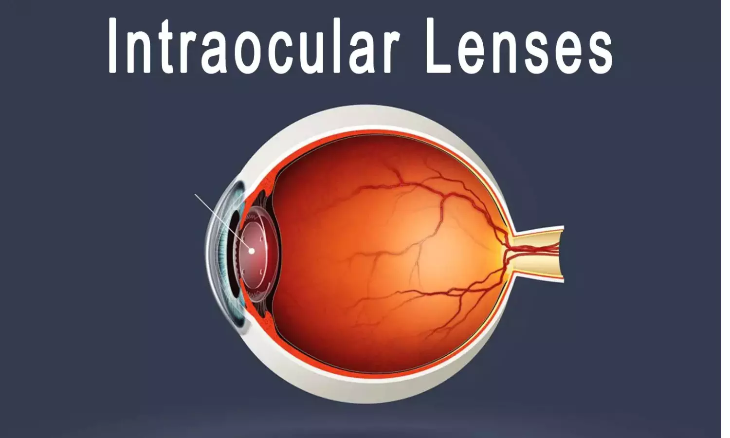 EDOF intraocular lens effective and acceptable in patients with previous vitrectomy