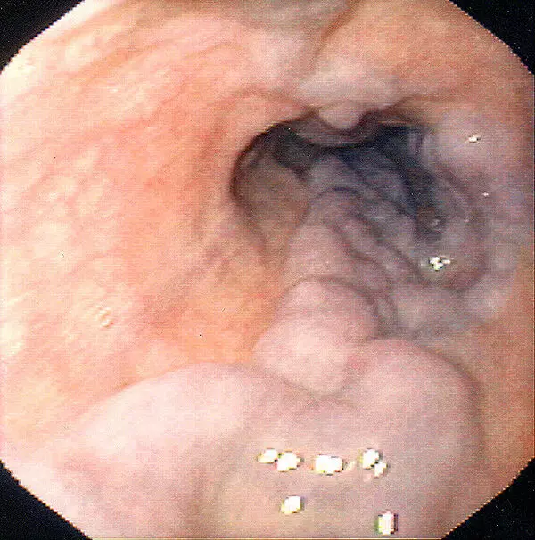 Endoscopic variceal ligation bests propranolol in preventing oesophageal variceal bleeding in HCC patients