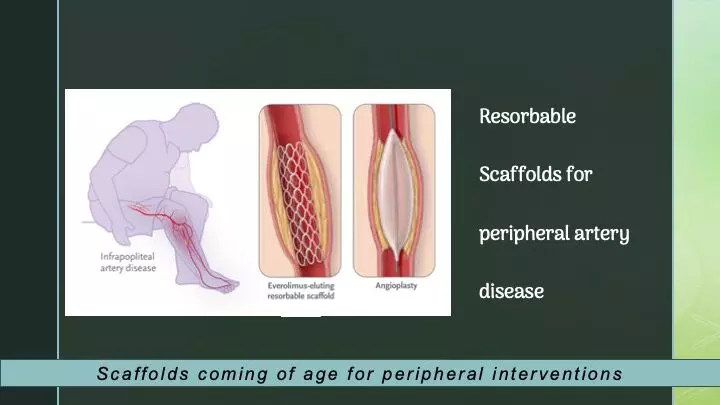 Resorbable scaffolds fare better than balloon angioplasty for infra-popliteal artery disease :NEJM